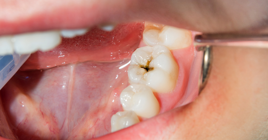 Close up picture of a cavity in a child’s mouth.